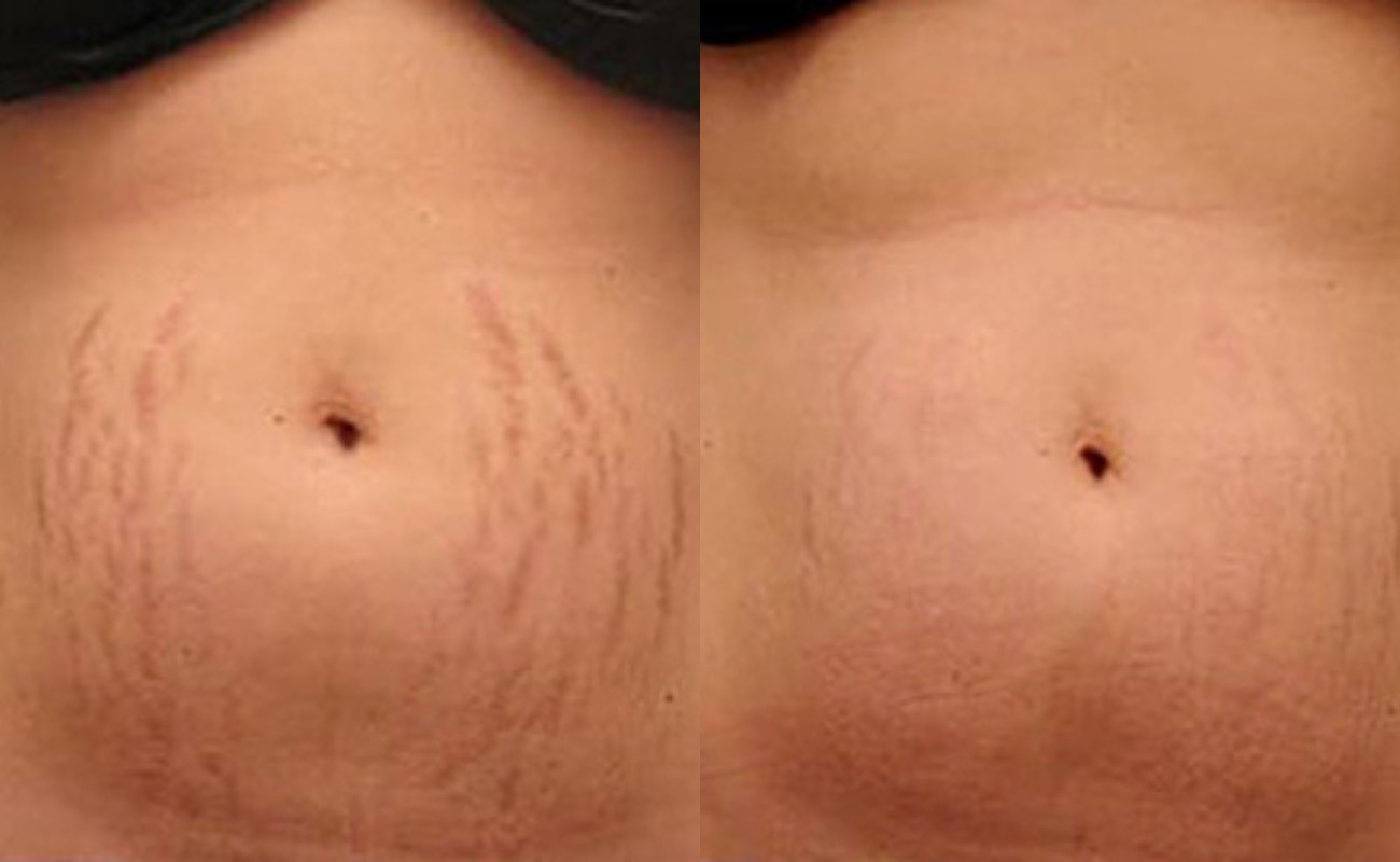 For Stretch Marks