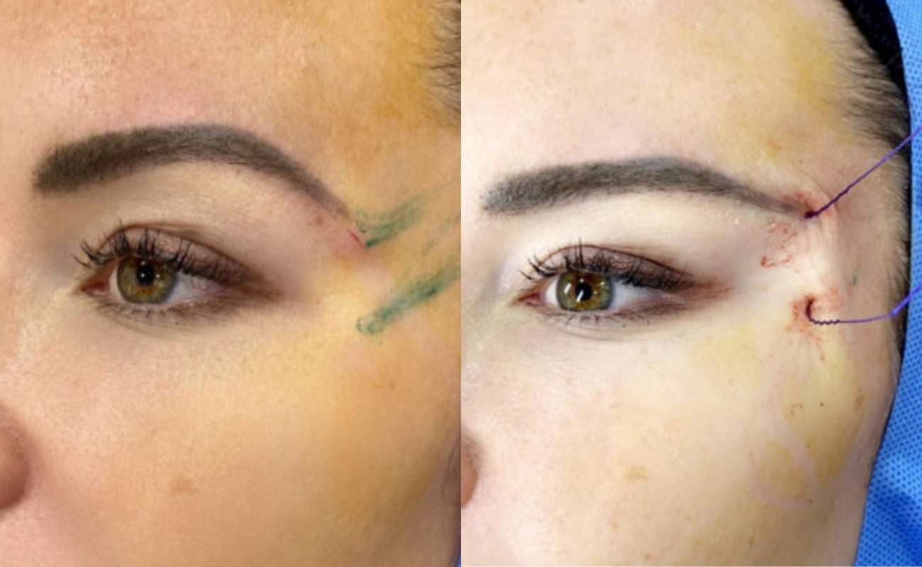 Molding Cog Threads Before And After Comparison