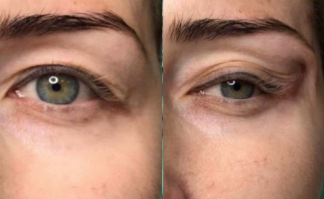 Molding Cog Threads Before And After Comparison