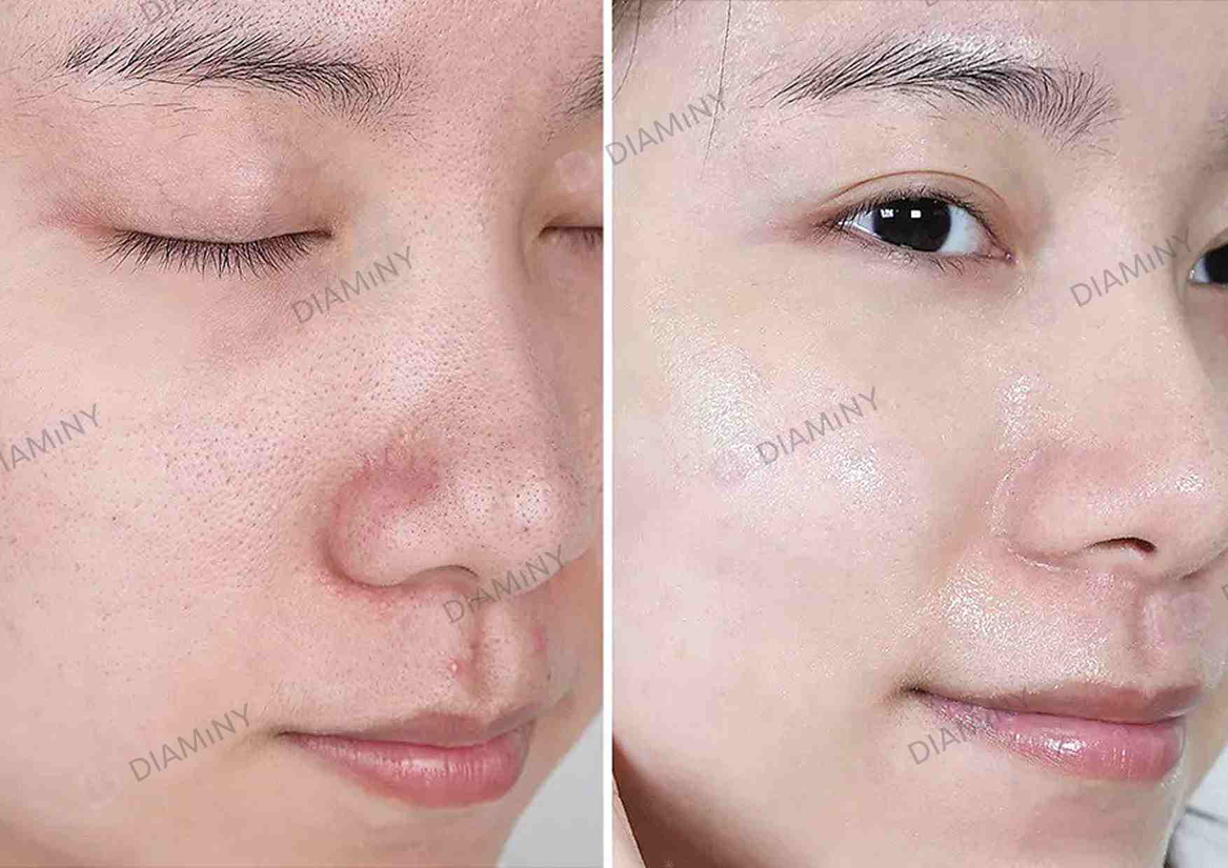 Non Cross Linked Hyaluronic Acid Mesotherapy