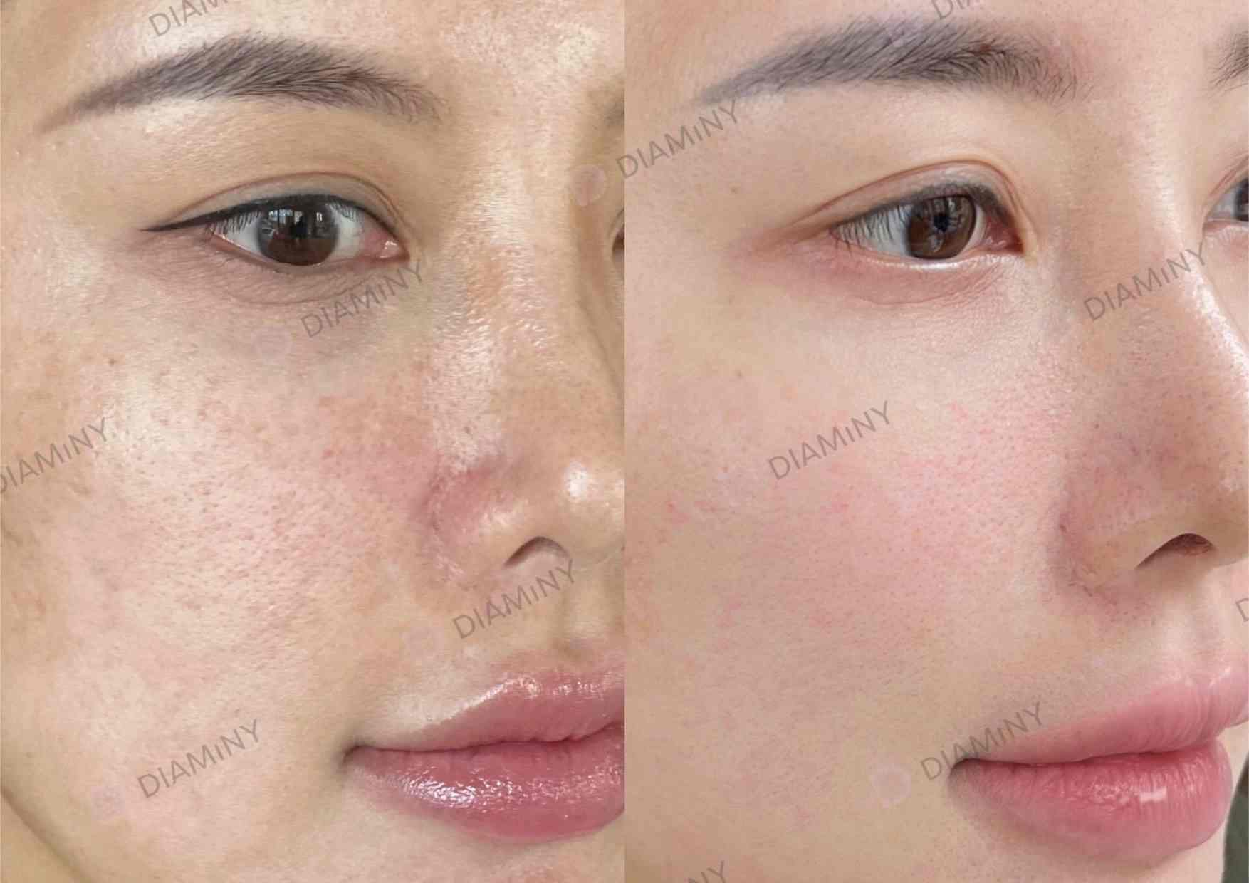 Non Cross Linked Hyaluronic Acid Mesotherapy