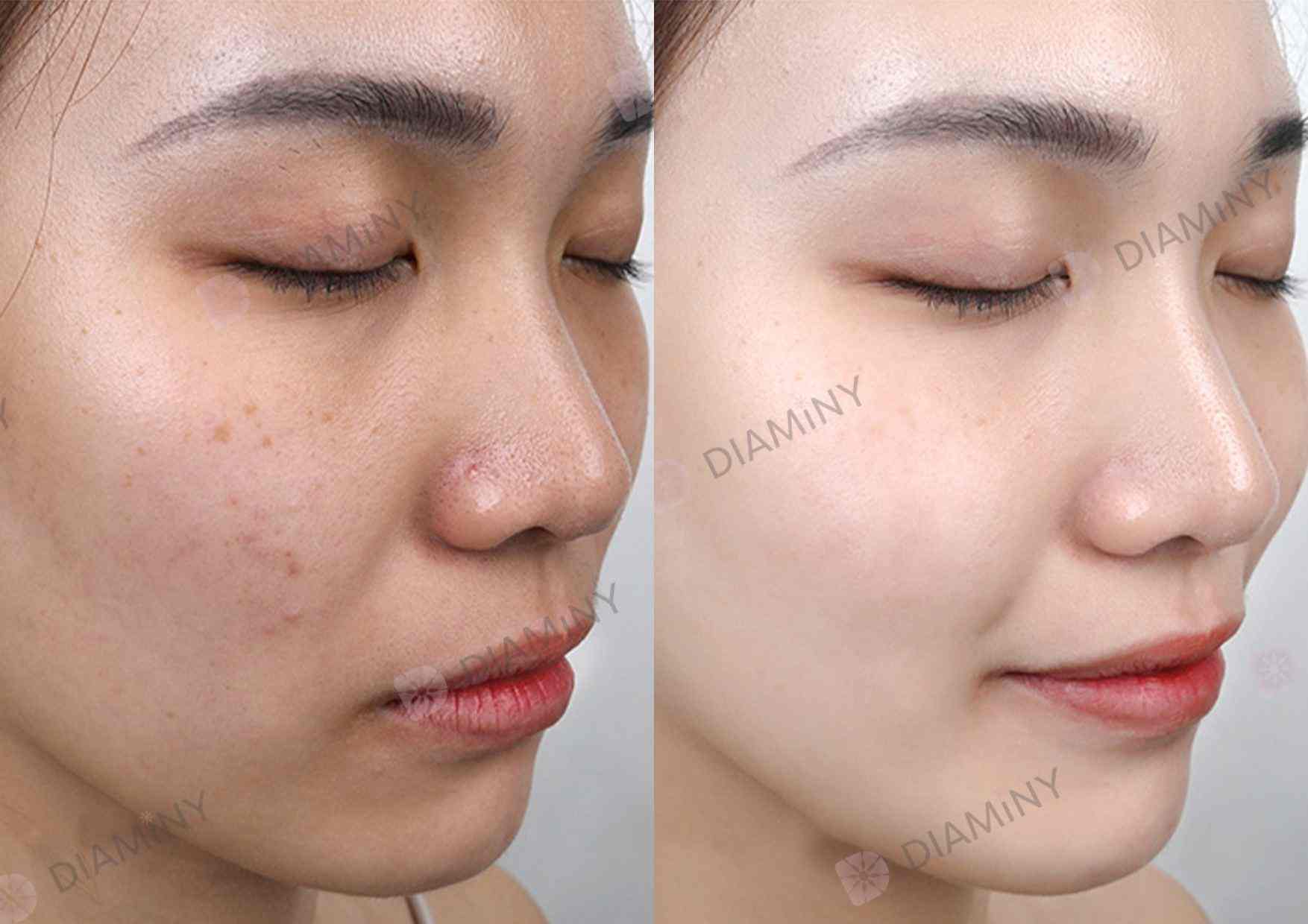 Non Cross Linked Hyaluronic Acid Mesotherapy