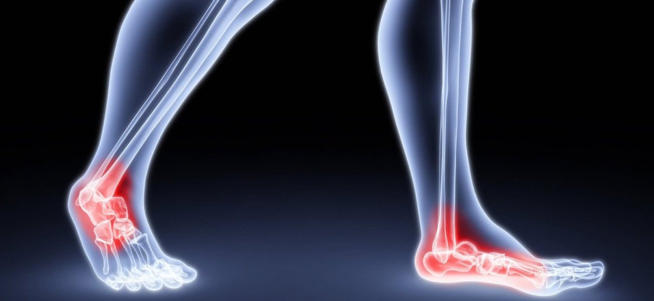 Traumatic Arthritis