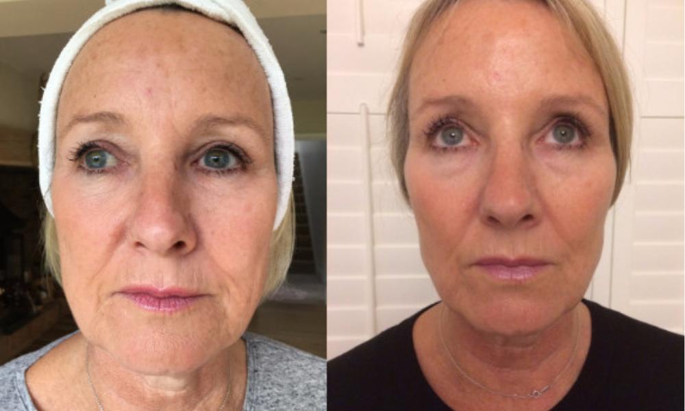 thread lift before and after