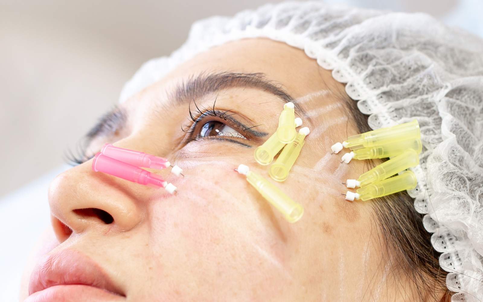 How Long Does it Take to Heal After a Thread Lift?