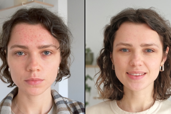 benefits of hydra needle treatment