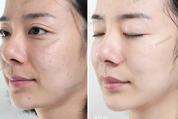 benefits of hydra needle treatment
