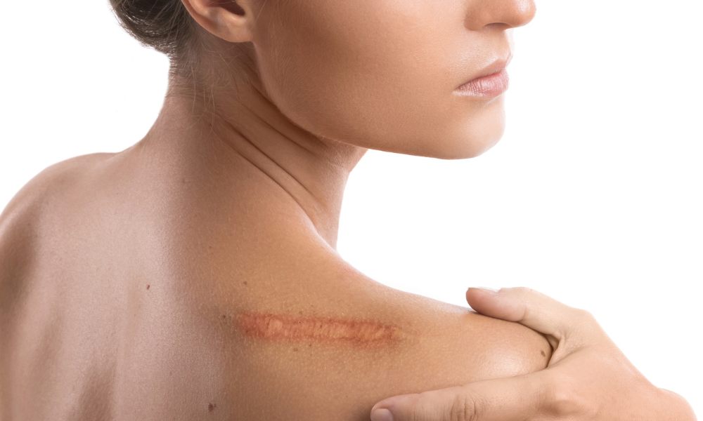 IPL Hair Removal side effects