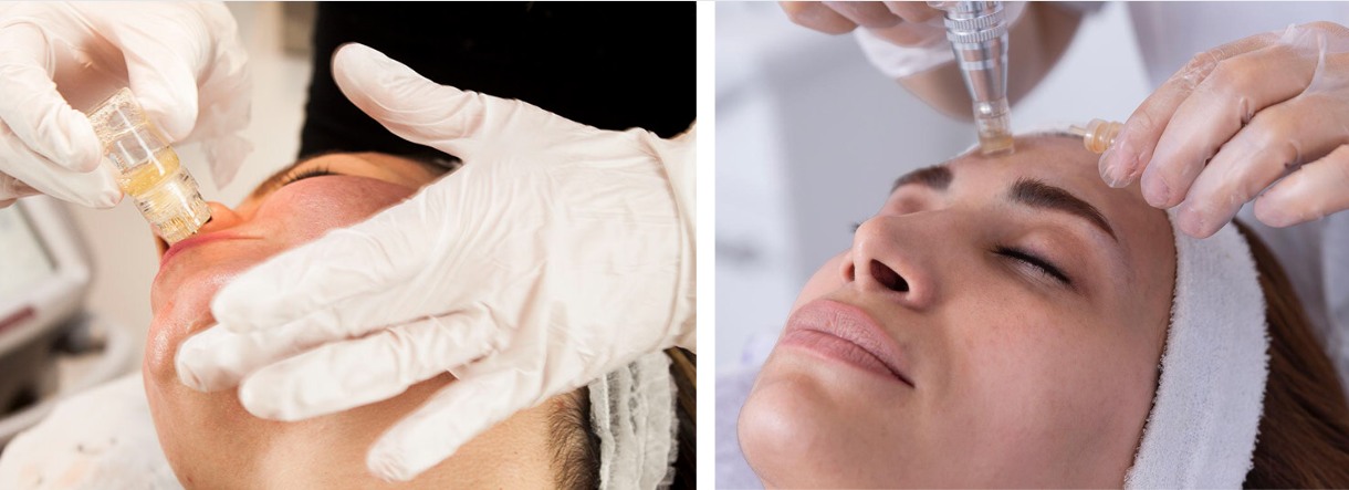 hydra needle stamp vs. microneedling