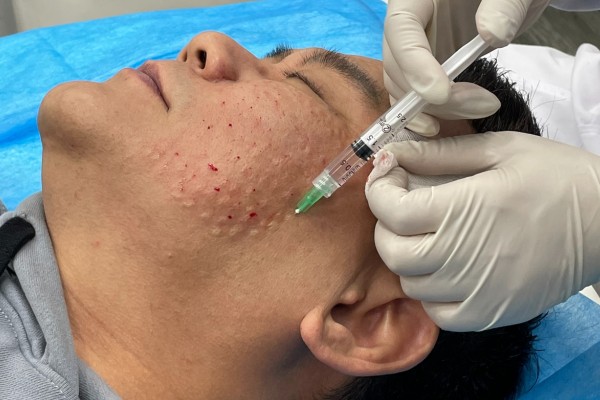 Facial treatment with 30G needle