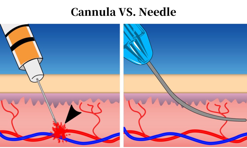 a Needle vs. a Blunt Tip Cannula