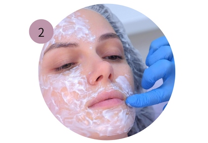 microneedling with derma pen procedure