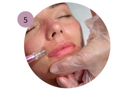 microneedling for face procedure