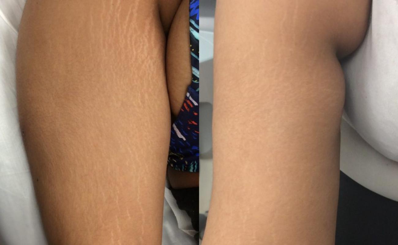 Dermapen for Stretch Marks Before And After