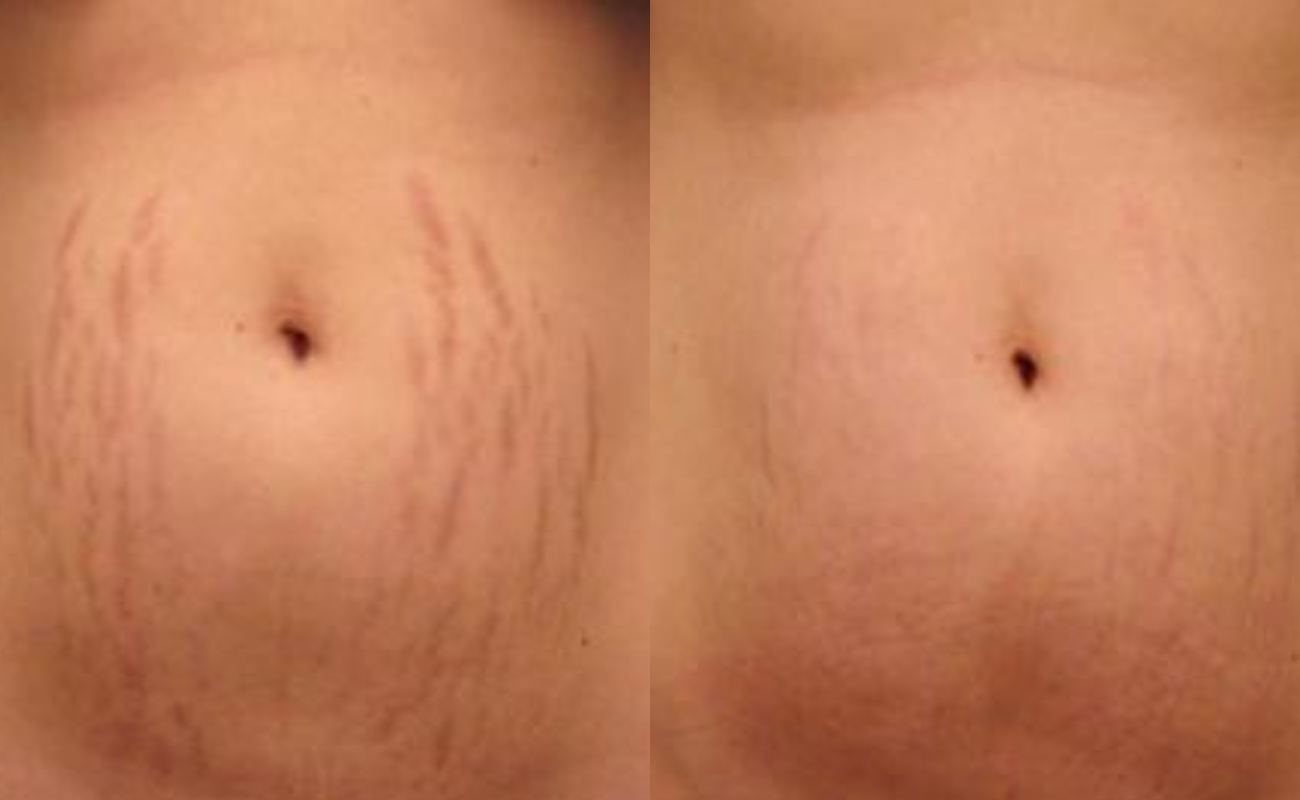 Dermapen for Stretch Marks Before And After