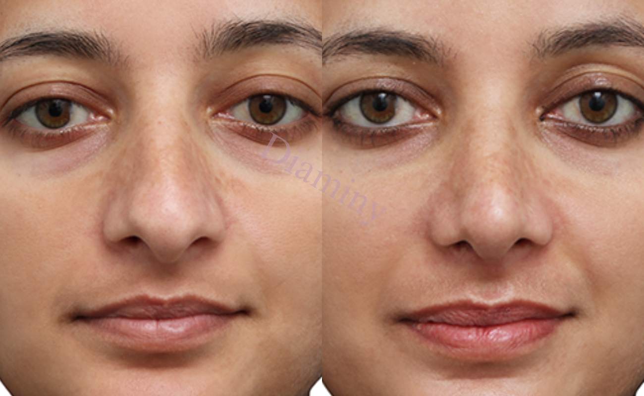 Diaminy Nose thread lift for wide nose
