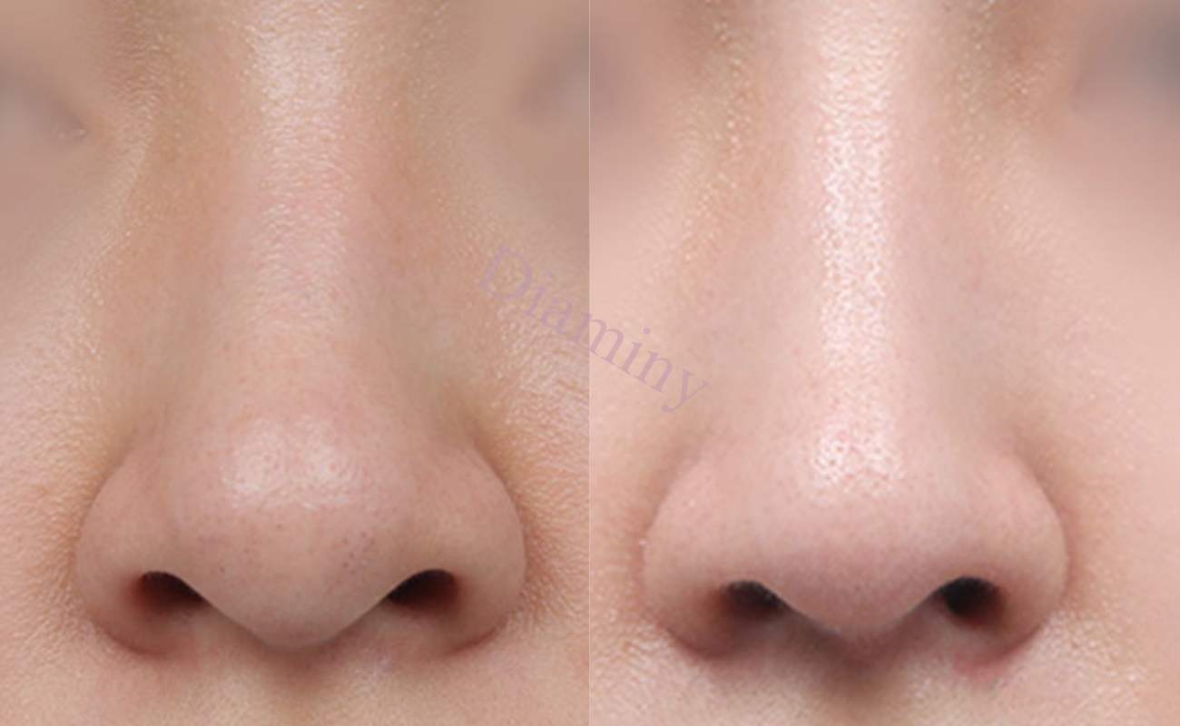 Diaminy Nose thread lift for wide nose