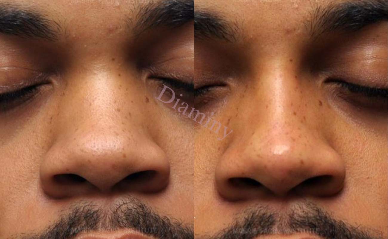 Diaminy Nose thread lift for wide nose