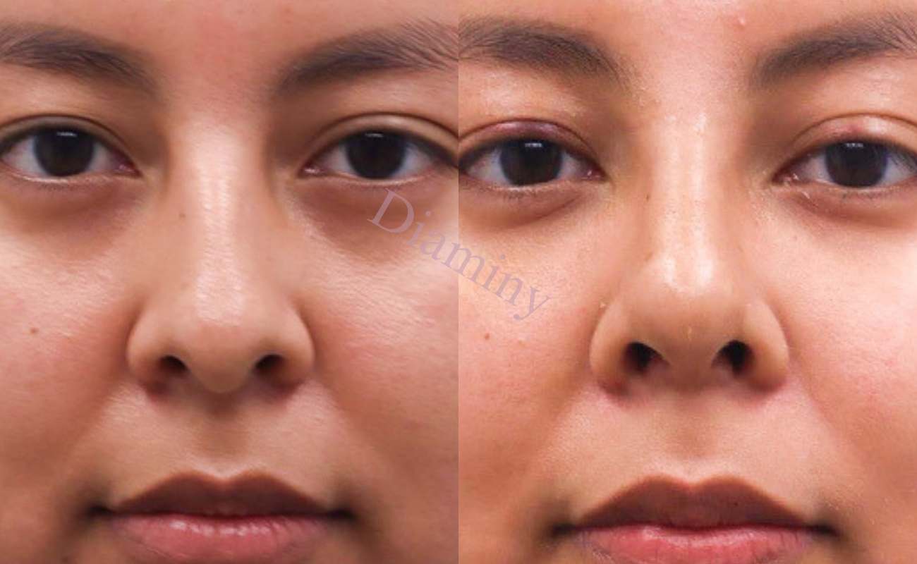 Diaminy Nose thread lift for wide nose