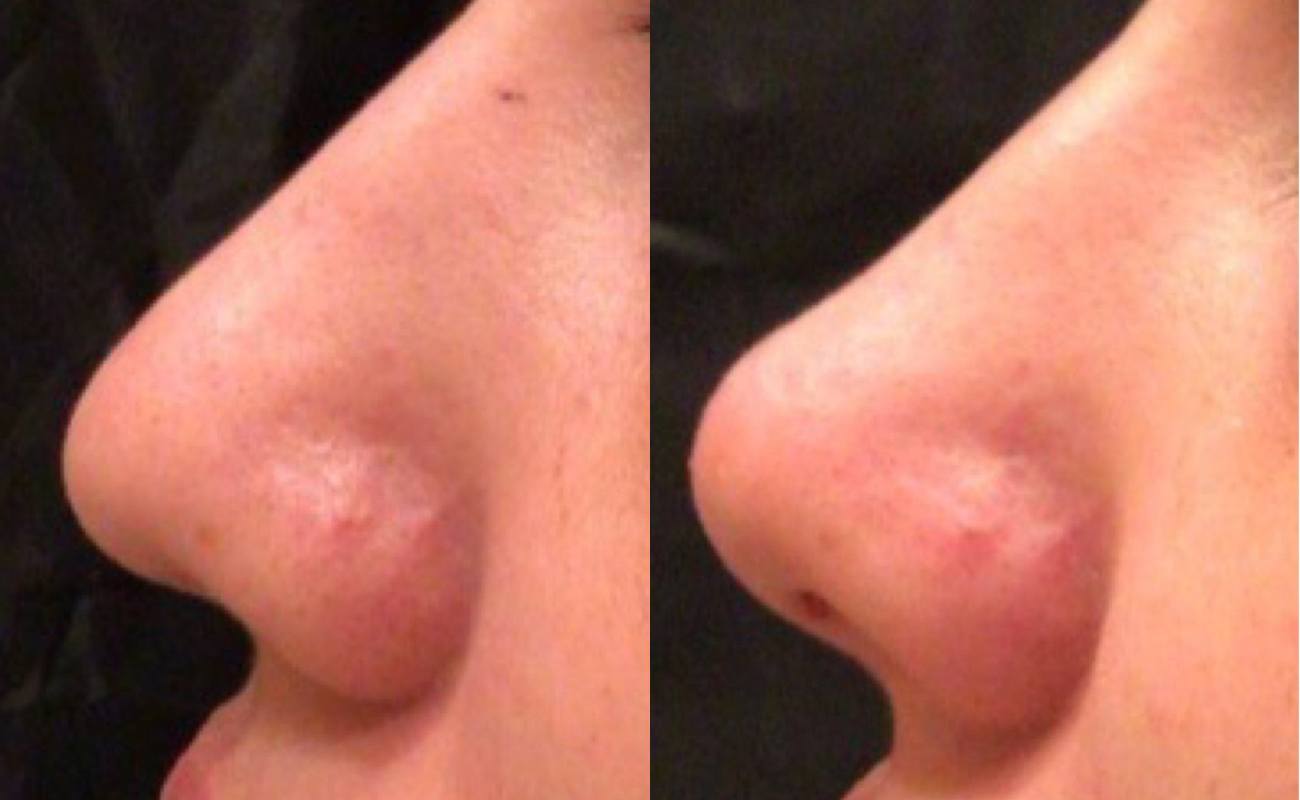 Diaminy PDO Threads Nose Before And After