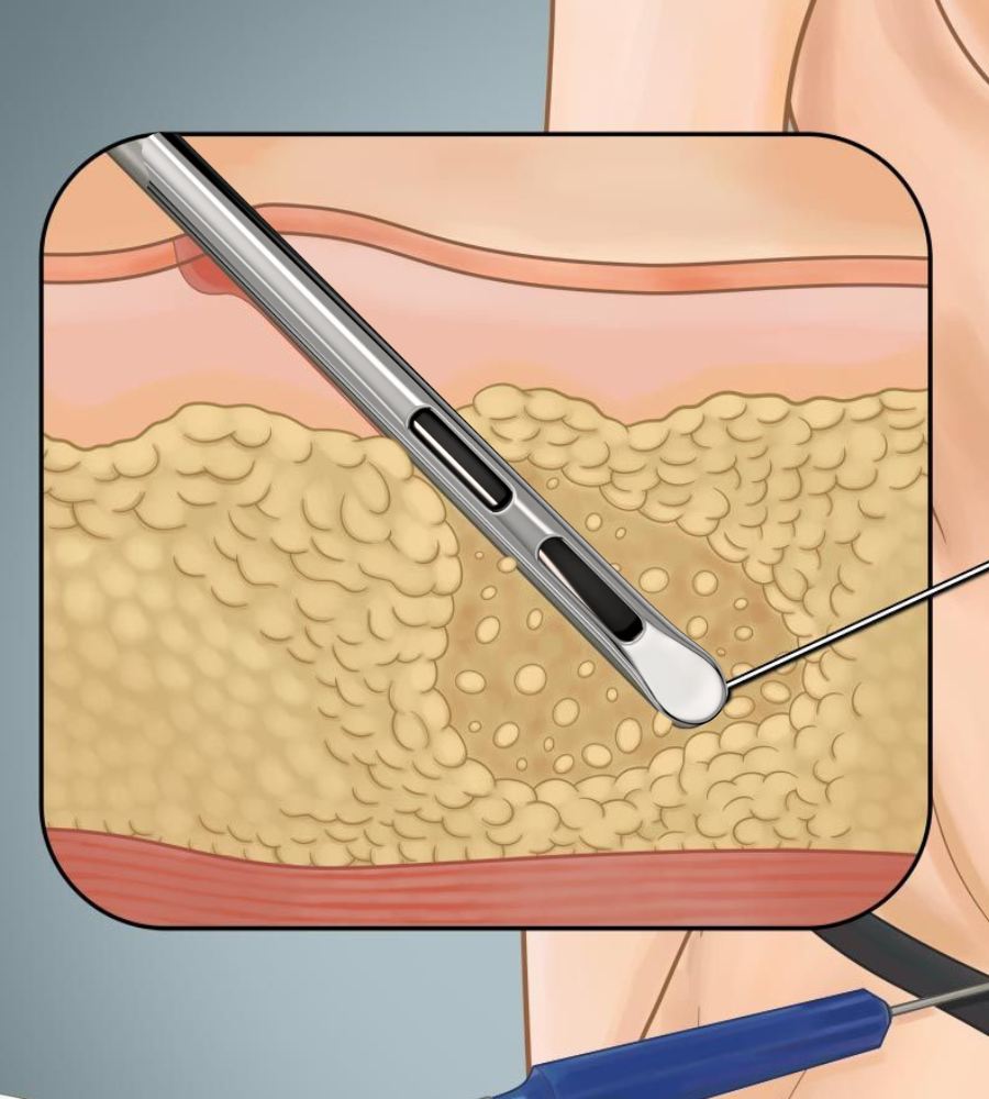 Double port for liposuction surgery