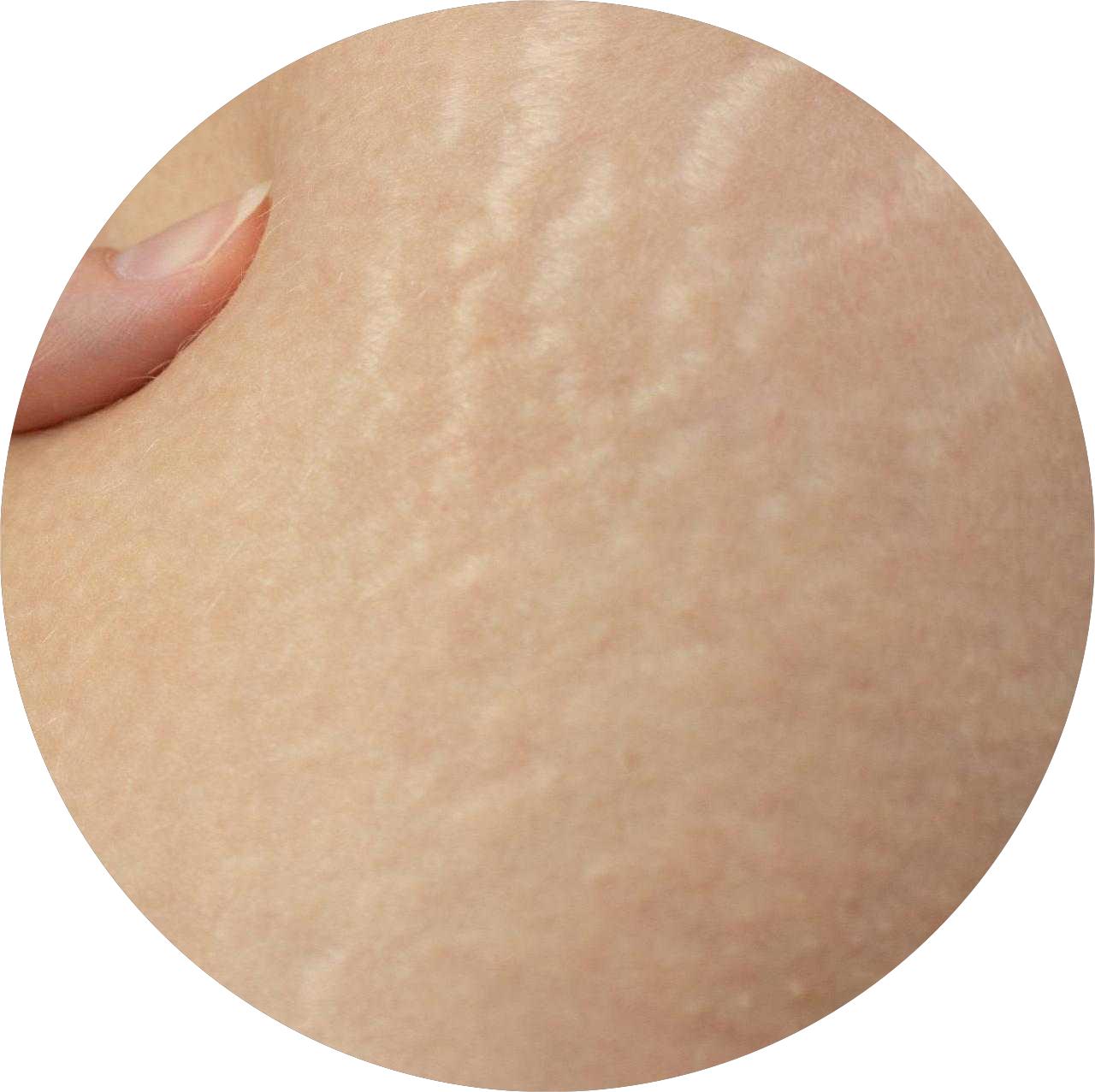 How to Use Dermapen for Stretch Marks at Home