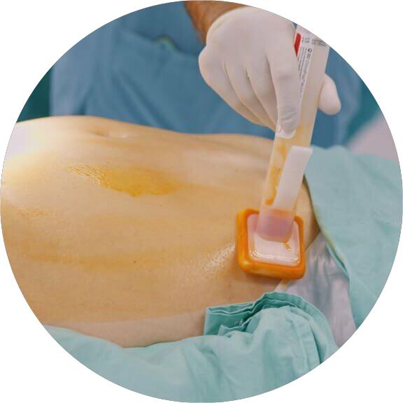 How to Use Dermapen for Stretch Marks at Home