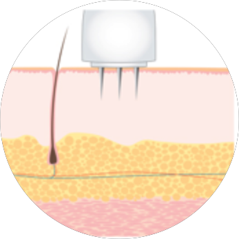 How to Use Dermapen for Stretch Marks at Home