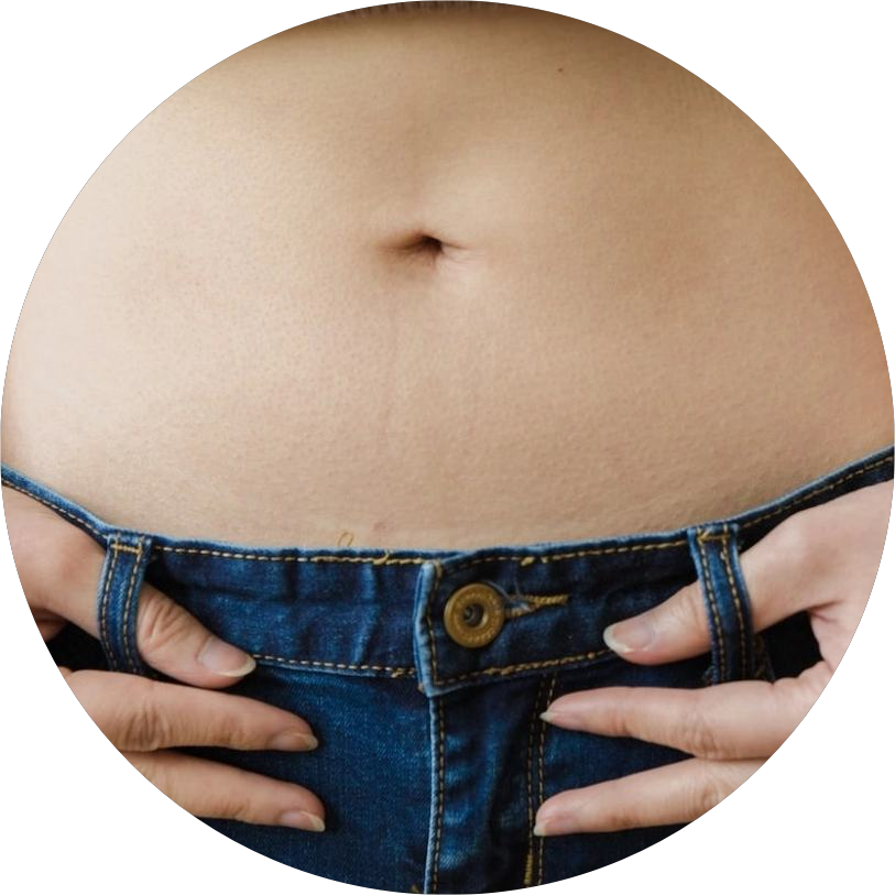 How to Use Dermapen for Stretch Marks at Home