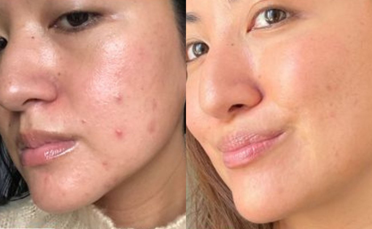 Hydra needle for acne marks