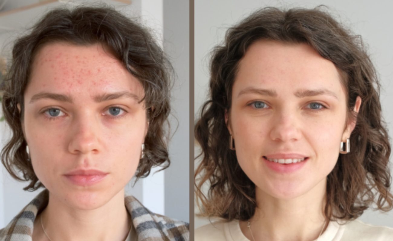 Hydra needle for acne marks