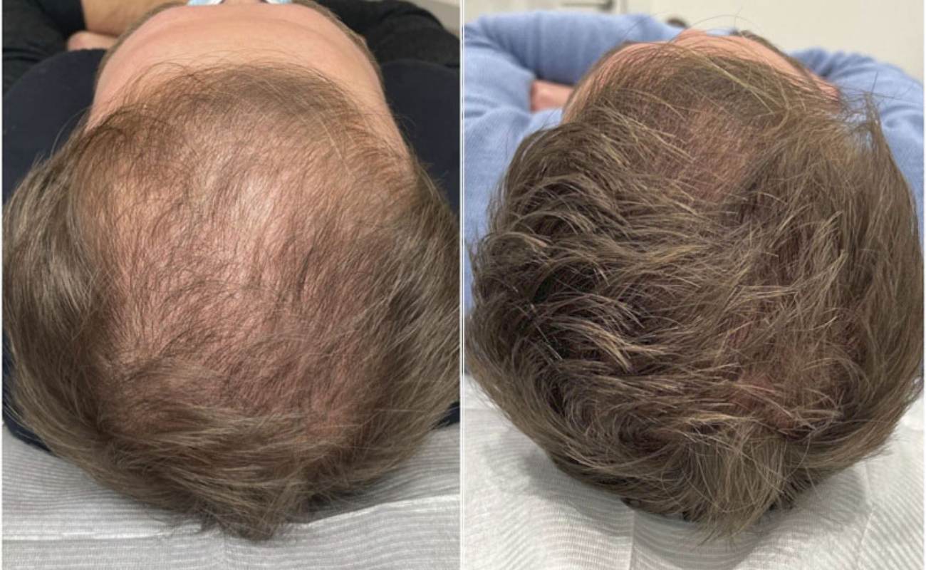 Hydra needle for hair loss