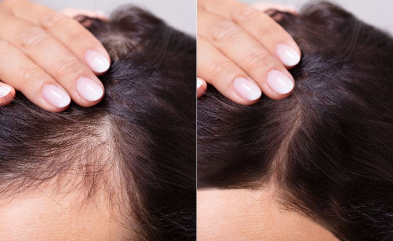 Hydra needle for hair loss