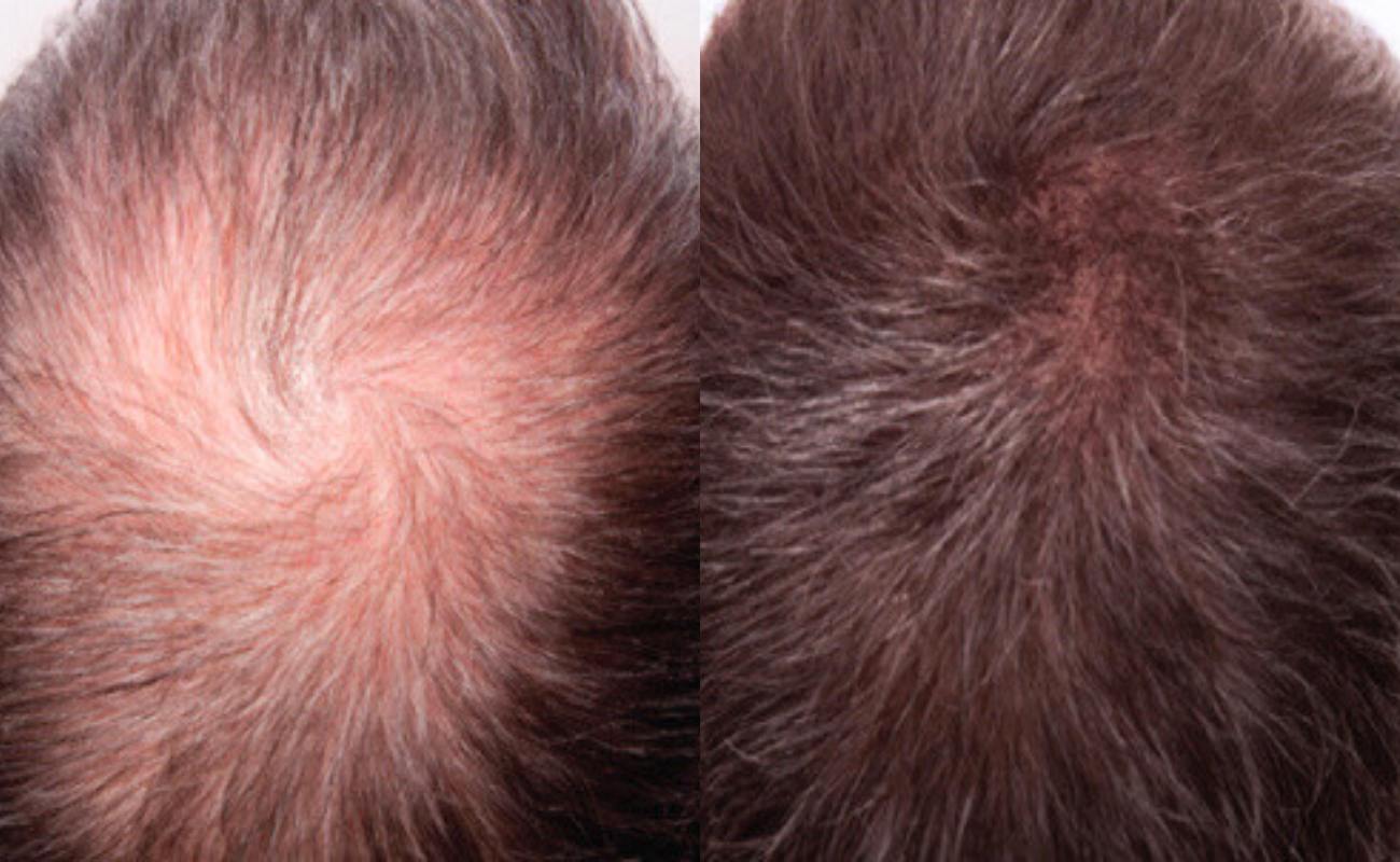 Hydra needle for hair loss