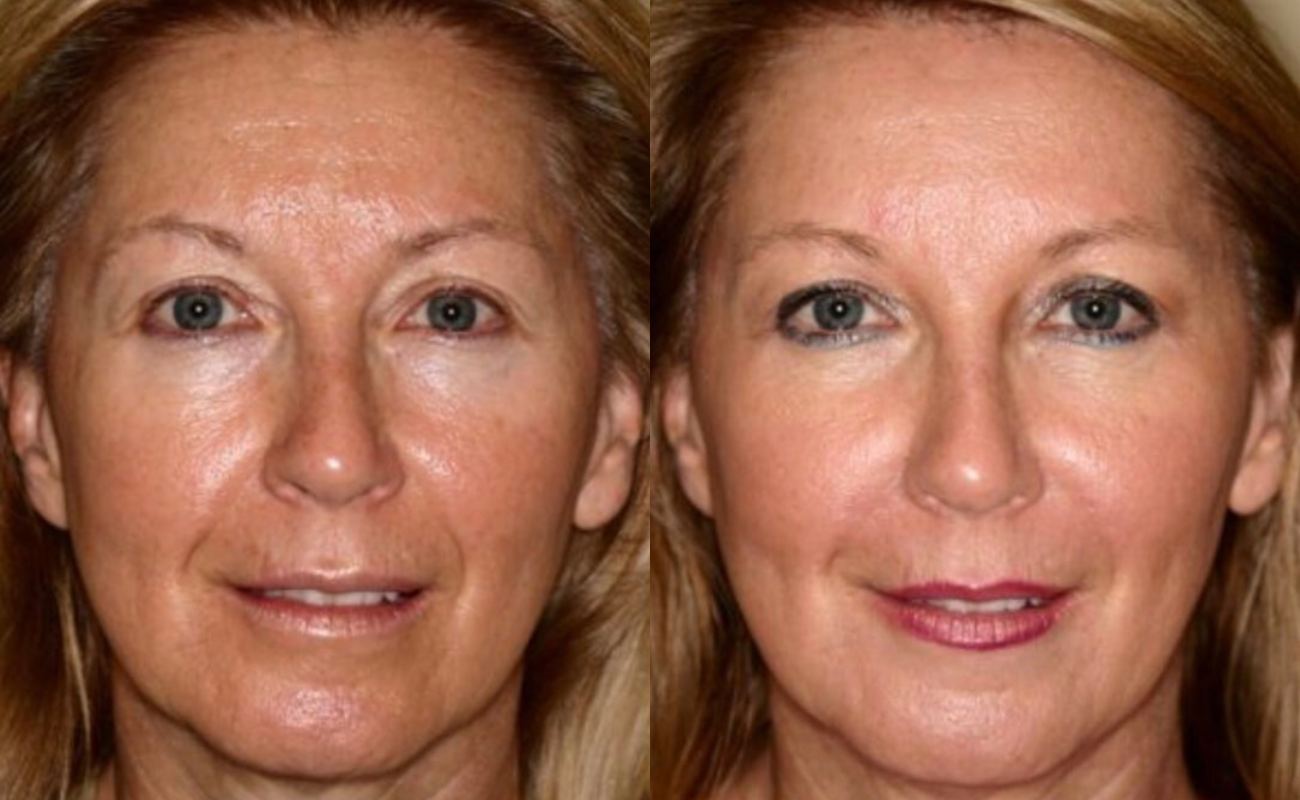 Hydra needle for lighten spots