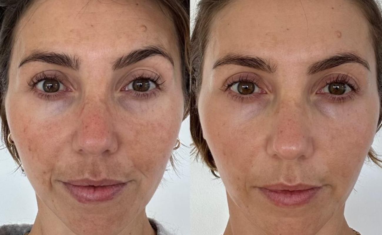 Hydra needle for lighten spots