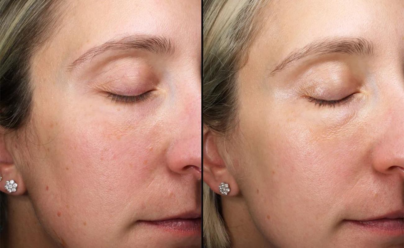 Hydra needle for lighten spots