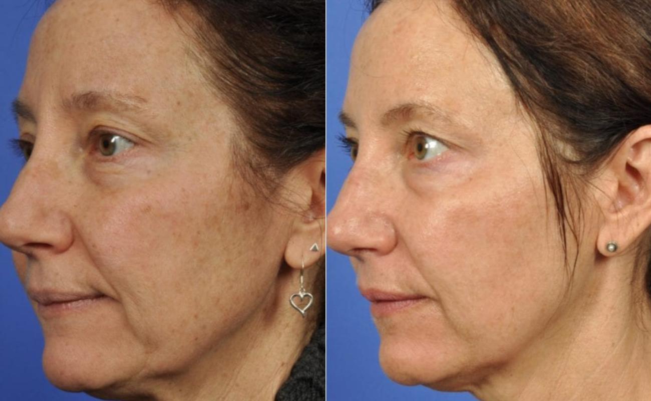 Hydra needle to remove fine lines