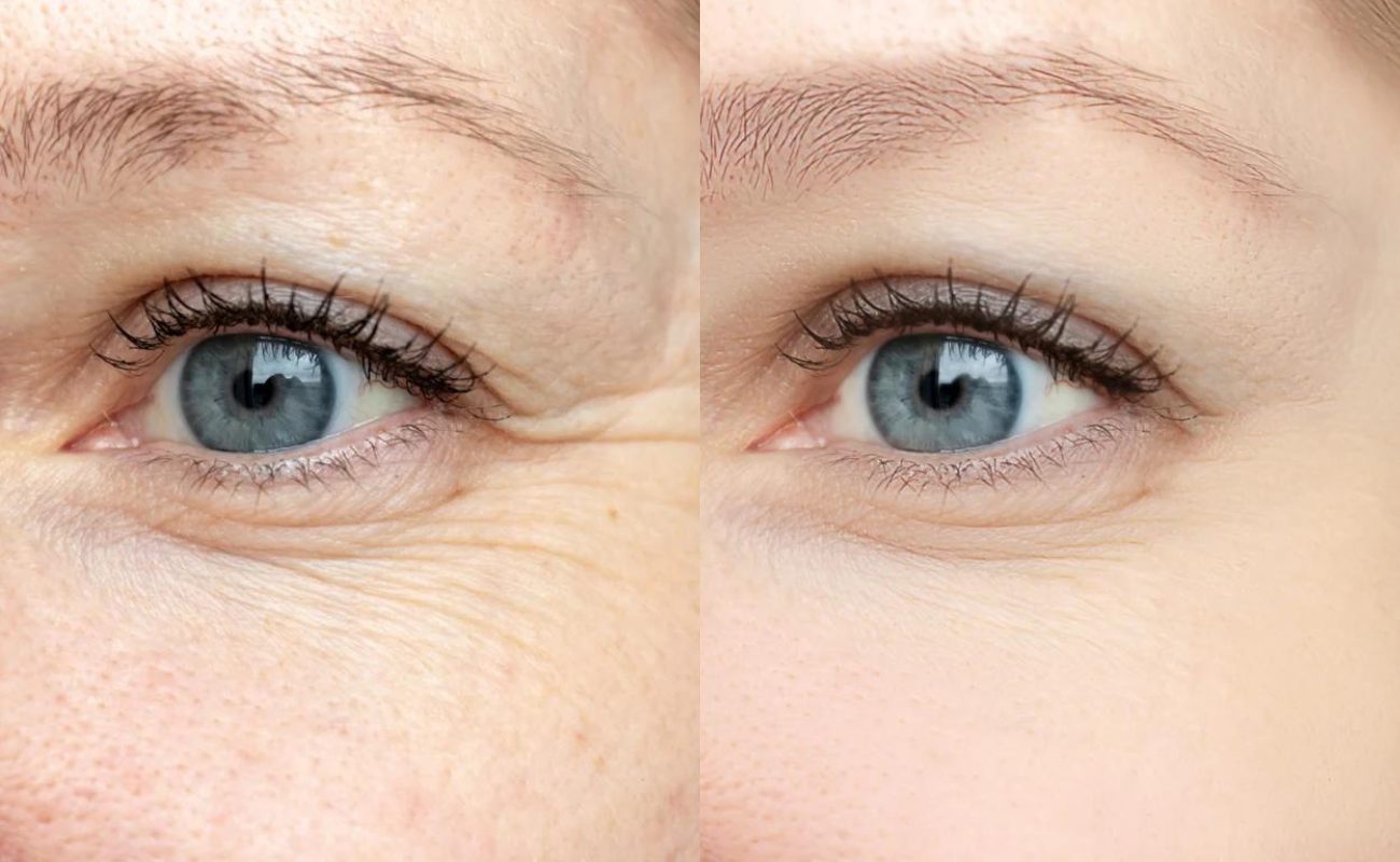 Hydra needle to remove fine lines