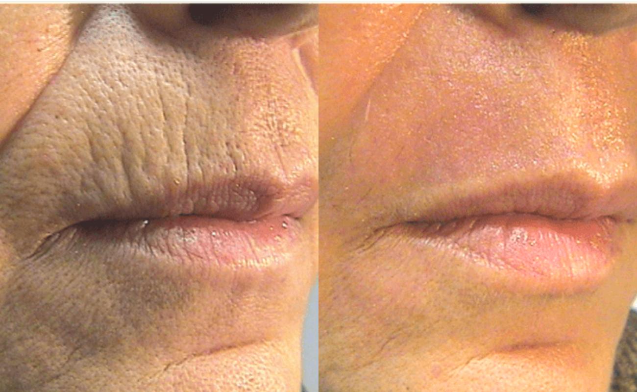 Hydra needle to remove fine lines