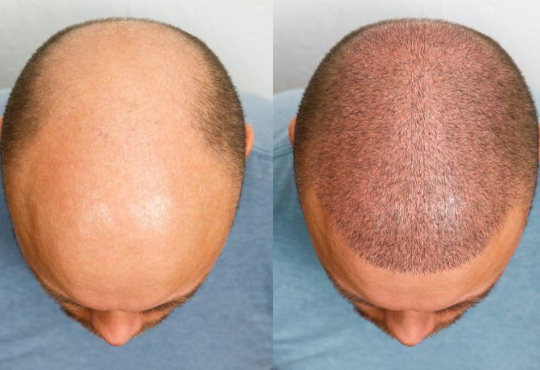 Hydra roller for Scalp treatment