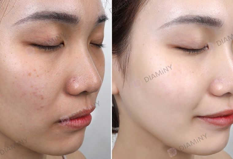 Hydra roller for Skin Smooth Treatment