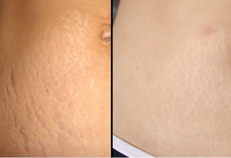 Hydra roller for stretch marks