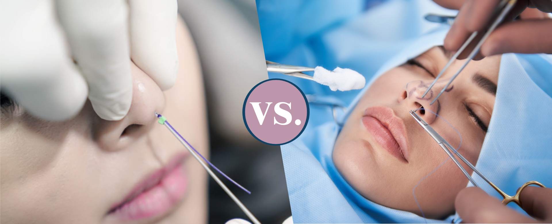 Nose Job with PDO Threads VS Traditional Rhinoplasty
