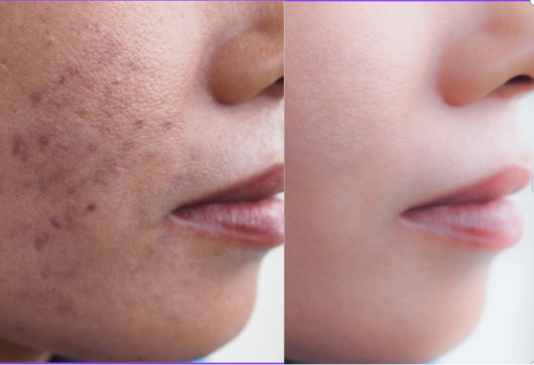 Skin smoothing treatment