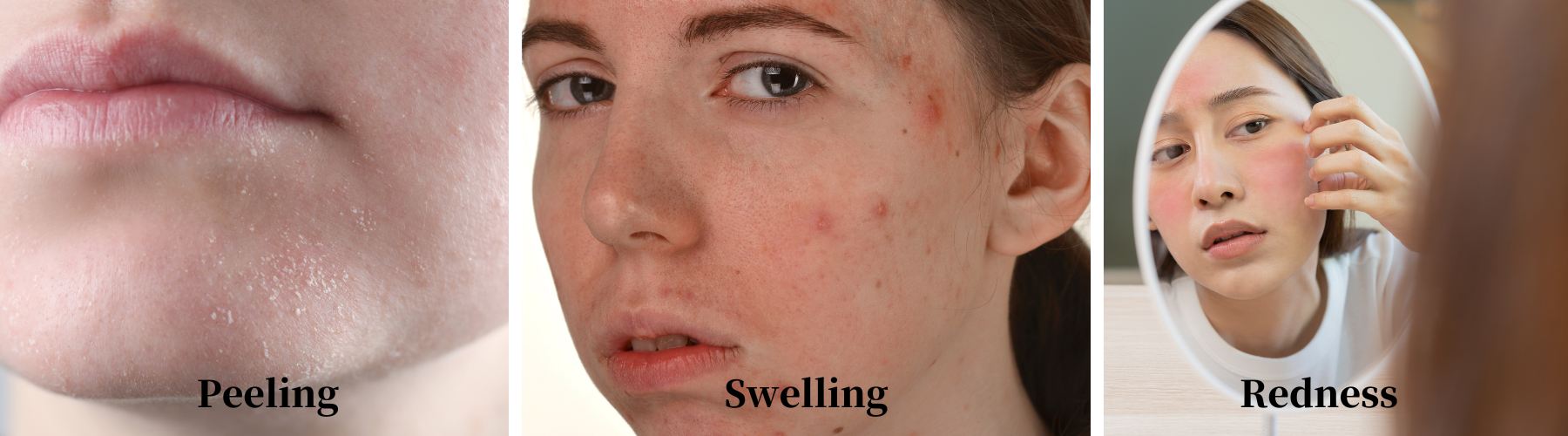 microneedling's side effects