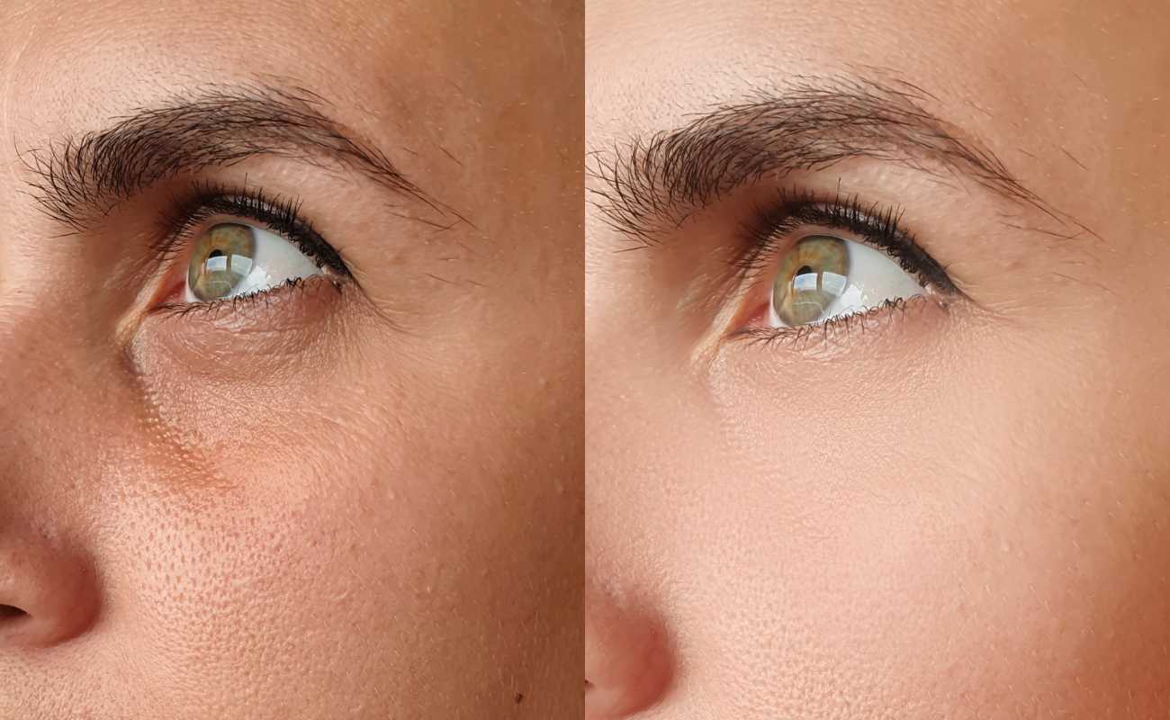 Before and after pictures of the eye