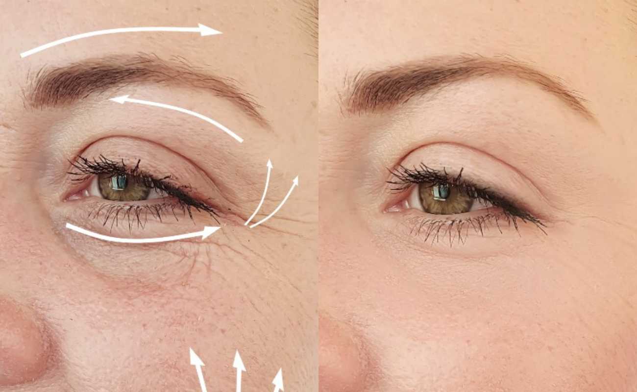 Before and after pictures of the eye