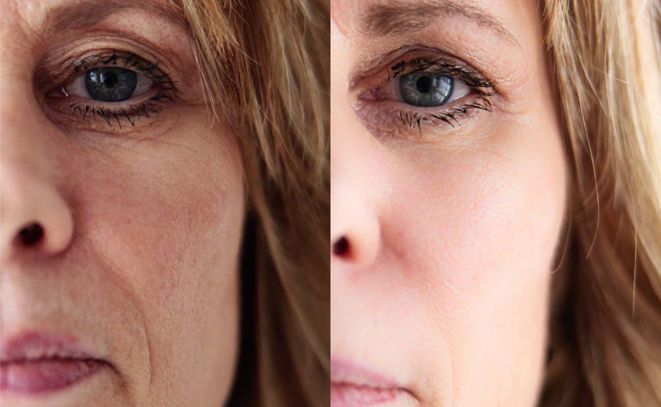 Before and after pictures of the eye