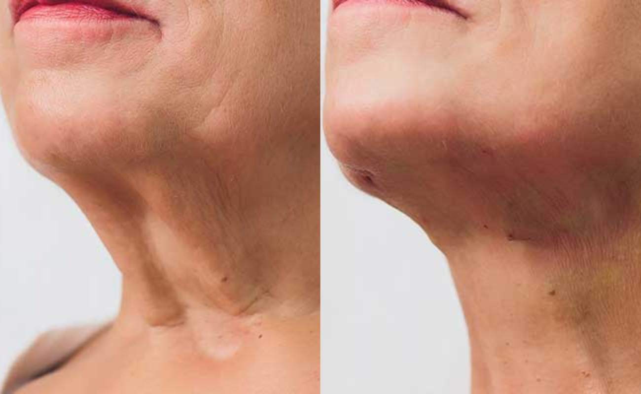 Before and after pictures of the neck